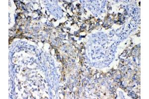 IHC testing of FFPE human lung cancer tissue with SCF antibody at 1ug/ml. (KIT Ligand anticorps)