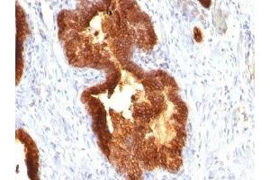 Formalin-fixed, paraffin-embedded human prostate carcinoma stained with Cytokeratin 18 antibody (KRT18/835). (Cytokeratin 18 anticorps)
