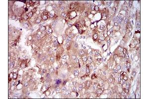 Immunohistochemical analysis of paraffin-embedded liver cancer tissues using PON1 mouse mAb with DAB staining.