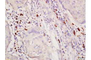 Formalin-fixed and paraffin embedded human lung cancer labeled with Rabbit Anti-SGK1 (Thr256) Polyclonal Antibody, Unconjugated 1:200 followed by conjugation to the secondary antibody and DAB staining (SGK1 anticorps  (pThr256))
