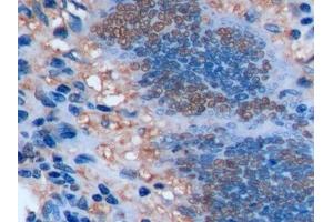 Detection of Ki-67 in Human Colorectal cancer Tissue using Polyclonal Antibody to Ki-67 Protein (Ki-67) (Ki-67 anticorps  (AA 2815-2928))