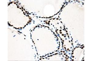 Immunohistochemical staining of paraffin-embedded Adenocarcinoma of ovary tissue using anti-LOXmouse monoclonal antibody. (LOX anticorps  (AA 22-168))
