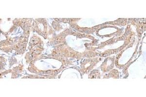 Immunohistochemistry of paraffin-embedded Human thyroid cancer tissue using PLGLB2 Polyclonal Antibody at dilution of 1:65(x200) (PLGLB2 anticorps)
