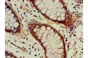 Immunohistochemistry of paraffin-embedded human colon cancer using ABIN7142946 at dilution of 1:100