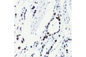 Immunohistochemistry of paraffin-embedded human gastric cancer using Acetyl-Histone H2B-K5 antibody (ABIN7267733) at dilution of 1:100 (40x lens). (Histone H2B anticorps  (acLys5))