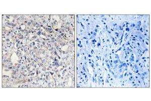 Immunohistochemistry analysis of paraffin-embedded human liver carcinoma tissue, using Heparin Cofactor II antibody. (SERPIND1 anticorps  (N-Term))