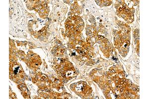 ABIN7094416 and ABIN7098463 at 1/100 staining Human breast cancer by IHC-P.