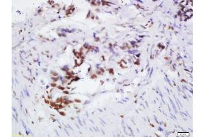 Formalin-fixed and paraffin embedded human colon cancer labeled with Rabbit Anti-OGG1 Polyclonal Antibody, Unconjugated 1:200 followed by conjugation to the secondary antibody and DAB staining, (OGG1 anticorps  (AA 151-250))