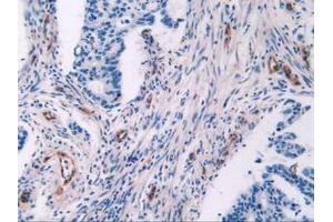 IHC-P analysis of Human Rectum Cancer Tissue, with DAB staining. (Endoglin anticorps  (AA 26-136))