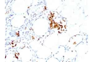 Formalin-fixed, paraffin-embedded human Angiosarcoma stained with Glycophorin A Mouse Monoclonal Antibody (GYPA/280). (CD235a/GYPA anticorps)