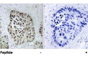 Immunohistochemical analysis of paraffin-embedded human lung carcinoma tissue using DCLRE1C polyclonal antibody . (DCLRE1C anticorps)