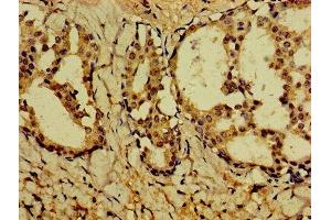 Immunohistochemistry of paraffin-embedded human breast cancer using ABIN7162672 at dilution of 1:100