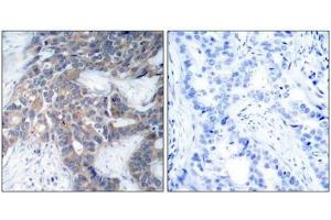 Immunohistochemical analysis of paraffin-embedded human breast carcinoma tissue using MEK1/MEK2(Phospho-Ser217/Ser221) Antibody(left) or the same antibody preincubated with blocking peptide(right).