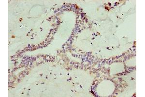 Immunohistochemistry of paraffin-embedded human breast cancer using ABIN7168634 at dilution of 1:100