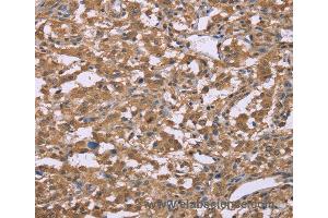 Immunohistochemistry of Human thyroid cancer using IFNA2 Polyclonal Antibody at dilution of 1:40 (IFNA2 anticorps)