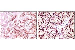 Immunohistochemical analysis of paraffin-embedded human breast carcinoma, using ER-alpha mouse mAb showing nuclear expression with DAB staining. (Estrogen Receptor alpha anticorps)
