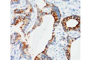 IHC-P: IGFBP3 antibody testing of human breast cancer tissue