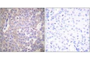 Immunohistochemistry analysis of paraffin-embedded human breast carcinoma tissue, using Claudin 2 Antibody. (Claudin 2 anticorps  (AA 181-230))