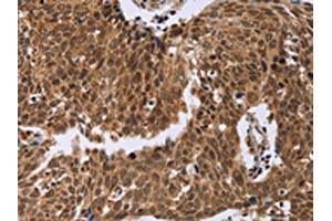The image on the left is immunohistochemistry of paraffin-embedded Human cervical cancer tissue using ABIN7129394(ERCC6L Antibody) at dilution 1/30, on the right is treated with fusion protein. (ERCC6L anticorps)