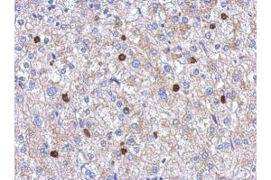 IHC-P Image Immunohistochemical analysis of paraffin-embedded human hepatoma, using MYST2, antibody at 1:250 dilution.