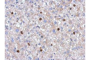 IHC-P Image Immunohistochemical analysis of paraffin-embedded human hepatoma, using MYST2, antibody at 1:250 dilution. (MYST2 anticorps  (Internal Region))