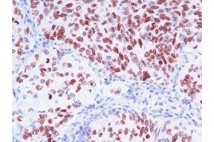 Formalin-fixed, paraffin-embedded human lung carcinoma stained with TTF1 antibody (8G7G3/1 + NX2. (TTF1 anticorps)