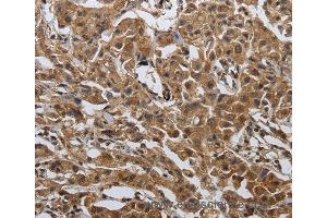 Immunohistochemistry of Human ovarian cancer using PDCD7 Polyclonal Antibody at dilution of 1:60 (PDCD7 anticorps)