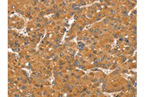 The image on the left is immunohistochemistry of paraffin-embedded Human liver cancer tissue using ABIN7131123(SNX11 Antibody) at dilution 1/30, on the right is treated with fusion protein. (SNX11 anticorps)