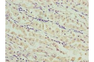 Immunohistochemistry of paraffin-embedded human gastric cancer using ABIN7159191 at dilution of 1:100
