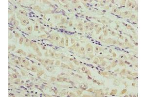 Immunohistochemistry of paraffin-embedded human gastric cancer using ABIN7159191 at dilution of 1:100 (MND1 anticorps  (AA 2-205))