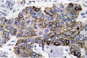 Immunohistochemistry analysis of RANTES Antibody in paraffin-embedded human lung carcinoma tissue.