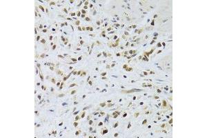 Immunohistochemistry of paraffin-embedded human gastric cancer using RAD50 Antibody. (RAD50 anticorps)