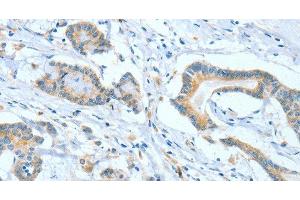 Immunohistochemistry of paraffin-embedded Human colon cancer tissue using ASCC1 Polyclonal Antibody at dilution 1:50