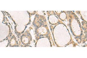 Immunohistochemistry of paraffin-embedded Human thyroid cancer tissue using KIF2C Polyclonal Antibody at dilution of 1:70(x200)
