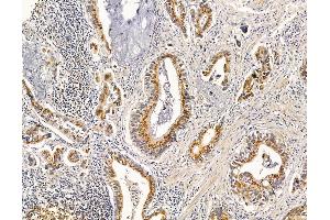 ABIN6264865 and ABIN6279751 at 1/100 staining human pancreatic cancer by IHC-P.