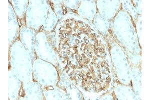Formalin-fixed, paraffin-embedded human Renal Cell Carcinoma stained with CD34 Recombinant Rabbit Monoclonal Antibody (HPCA1/2598R).