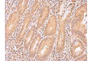 IHC-P Image IMPDH2 antibody detects IMPDH2 protein at cytosol on human colon carcinoma by immunohistochemical analysis.