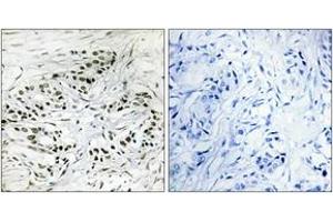 Immunohistochemistry analysis of paraffin-embedded human breast carcinoma tissue, using ERF Antibody. (ERF anticorps  (AA 471-520))