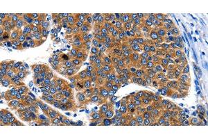 Immunohistochemistry of paraffin-embedded Human liver cancer using IGF2BP1 Polyclonal Antibody at dilution of 1:40 (IGF2BP1 anticorps)