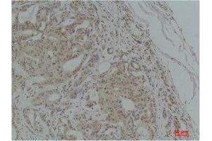 Immunohistochemistry (IHC) analysis of paraffin-embedded Human Breast Carcinoma using TGFbeta1 Polyclonal Antibody. (TGFB1 anticorps)