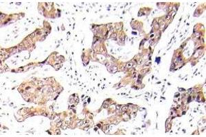 Immunohistochemistry (IHC) analyzes of p-FKHR/FOXO1A antibody in paraffin-embedded human breast carcinoma tissue. (FOXO1 anticorps  (pSer256))