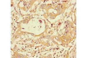 Immunohistochemistry of paraffin-embedded human pancreatic cancer using ABIN7160703 at dilution of 1:100 (PGLYRP2 anticorps  (AA 22-576))