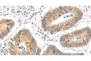 Immunohistochemistry of paraffin-embedded Human colon cancer using MAGED1 Polyclonal Antibody at dilution of 1:30