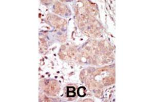 Formalin-fixed and paraffin-embedded human cancer tissue reacted with MAK polyclonal antibody  , which was peroxidase-conjugated to the secondary antibody, followed by DAB staining.