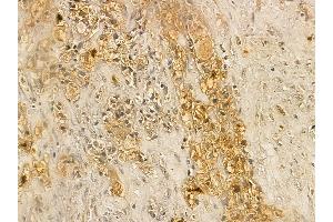 AWAT2 Mouse Monoclonal Antibody at 1/100 staining human kidney cancer by IHC-P. (AWAT2 anticorps  (Internal Region))