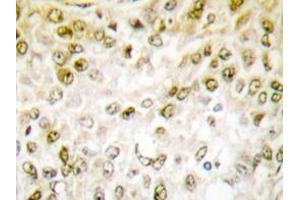 Immunohistochemistry analyzes of Chk1 antibody in paraffin-embedded human breast carcinoma tissue. (CHEK1 anticorps)