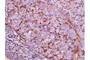 Formalin-fixed and paraffin embedded human lung carcinoma labeled with Rabbit Anti-pan-Cytokeratin Polyclonal Antibody, Unconjugated  at 1:200 followed by conjugation to the secondary antibody and DAB staining (Cytokeratin 1 anticorps  (AA 101-200))