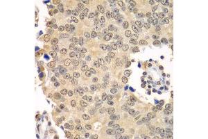 Immunohistochemistry of paraffin-embedded human prostate cancer using HDAC2 antibody. (HDAC2 anticorps  (C-Term))