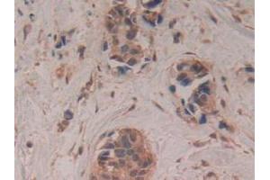 IHC-P analysis of Human Breast Cancer Tissue, with DAB staining. (GAP43 anticorps  (AA 1-274))