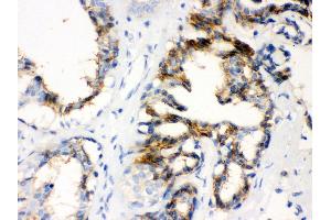 Anti- CTGF Picoband antibody, IHC(P) IHC(P): Human Mammary Cancer Tissue